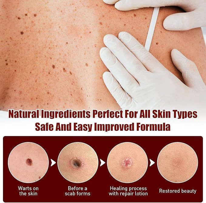 Tags and Moles Remover